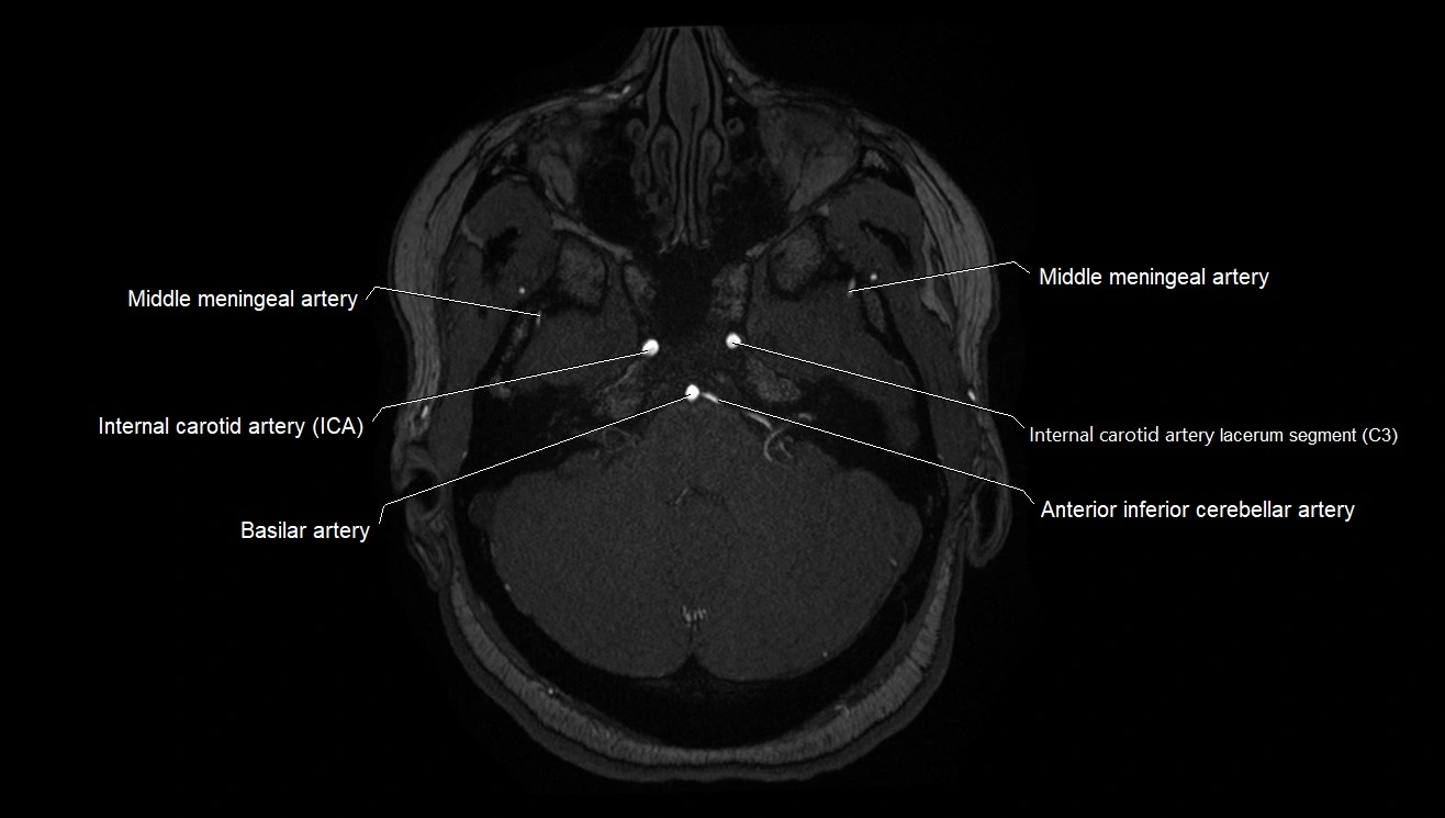 MRA brain (cerebral arteries) anatomy axial 3T image 3.webp